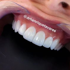 1,355 likes, 104 comments - drhenriquetavares on April 14, 2020: "WhatsApp 062-984911991 . Profissional responsável C.D. Dr Henrique Ferreira Tavares CRO-Go 9152 ..." Perfect Teeth Smile, Teeth Makeover, Perfect Smile Teeth, Teeth Aesthetic, Pretty Teeth, Botox Lips, Tea Health, Cute Braces, Veneers Teeth