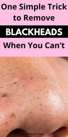 Remove Blackheads From Nose, Blind Pimple, Blackhead Remedies, Blackheads On Nose, Rid Of Blackheads, Black Heads, Blackhead Mask, Blackheads Removal