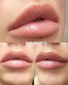 Lip Fillers Shapes, Keyhole Lips, Lip Injections Juvederm, Lip Plastic Surgery, Lip Goals, Lip Ideas, Juvederm Lips, Lip Surgery