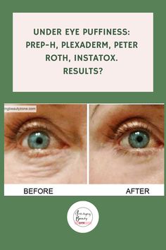 Explore effective remedies for under-eye puffiness! Discover remarkable before and after results achieved through the use of Ageless, Thomas Roth, Preparation-H, or Plexaderm as alternatives for DIY treatments targeting eye bags. Natural Diy