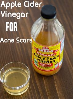 Apple Cider Vinegar For Acne, Apple Cider Vinegar Acne, Apple Cider Vinegar Remedies, Apple Cider Vinegar For Hair, Unfiltered Apple Cider Vinegar, Apple Cider Vinegar Drink, Natural Acne, How To Get Rid Of Acne