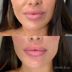 kysse + ashton — Miami Beach Botox Specialist Lip Filler Technique, Body Contouring Surgery, Lip Lift, Danielle Smith