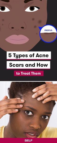 Here's what you need to know about the spots pimples leave behind. Chemical Peels, Acne Scar