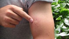 While most bug bites cause only mild symptoms, some bug bites can transmit disease. Read on to learn more about symptoms and how to prevent bug bites. Remedies For Mosquito Bites, Bug Bites Remedies, Anti Itch Cream, Mosquito Bite, Bug Bites, Insect Bites, Health And Beauty Tips, Natural Treatments, Health Remedies