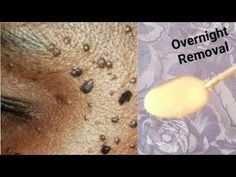 Here is a powerful treatment for Skin Tags, Skin Moles, Skin Warts. Apply every night and remove skin tag.Thanks for watching...Subscribe here: https://www.y... Pimples Under The Skin, Shampoo Recipe, Mole Removal, Diy Shampoo, Blemish Remover, Natural Teeth Whitening