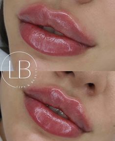 Lip Fillers Juvederm, 1ml Lip Filler, Stunning Makeup Looks, Earthy Vibes, Lip Filler