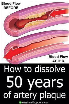 You may be at risk of a dangerous—even deadly— heart or brain disaster as a result of clogged arteries. But they don't have to stay that way! #HealthyHealthTips #DailyHealthTips Heart Or Brain, Artery Cleanse, Clogged Arteries, Health And Fitness Magazine, Healthy Diet Tips, Daily Health Tips, Soft Glam