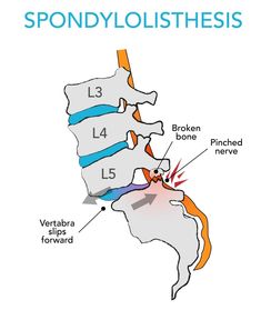 Radiology Schools, Nerve Pain Remedies, Anatomy Education, Forward Head Posture Exercises, Referred Pain, Nerve Health, Exercises At Home, Spine Health, Nerve Pain Relief