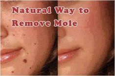 Natural Mole Removal, Moles On Face, Skin Moles, Mole Removal, Get Rid Of Warts, Skin Tags, Diy Skin Care Recipes, Skin Care Recipes, Free Life