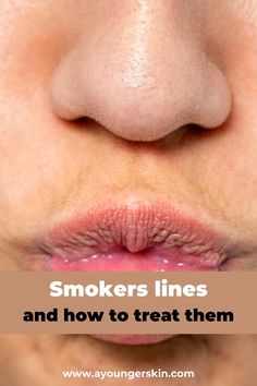 Lines Around Mouth, Face Wrinkles Remedies, Smokers Lines, Mouth Wrinkles, Wrinkle Remedies, Lip Wrinkles, Skin Care Wrinkles, Younger Skin, Face Wrinkles