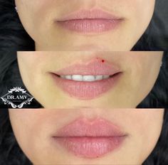 Eye Lift Surgery, Lip Surgery, Facial Procedure, Lips Inspiration, Face Fillers, Botox Lips, Facial Fillers, Lip Augmentation, Facial Aesthetics