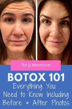 All your BOTOX questions answered here from your first appointment, downtime and the cost. Plus check out these mazing before & after results! After Botox Care, Botox For Beginners, Xeomin Before And After, Botox 11 Lines Before After, Botox Timeline, Before And After Botox Pictures, Before After Skincare, Botox Before After, Botox Benefits