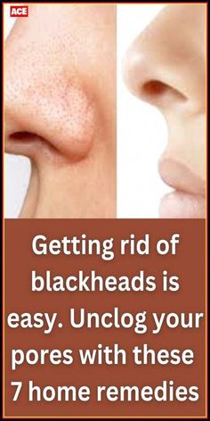 Getting Rid Of Blackheads, Pimples Under The Skin, Rid Of Blackheads, Blackhead Mask, Skin Natural Remedies, Cold Sores Remedies, Foaming Facial Cleanser, Natural Cold Remedies, Get Rid Of Blackheads