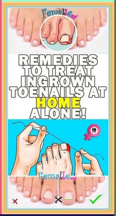 10 REMEDIES FOR INGROWN TOENAILS Ingrown Toenail Remedy, Ingrown Toenail, Ingrown Nail, Health Signs, Tongue Health, Ingrown Toe Nail, Toenail Fungus, Health Guide, Nail Fungus