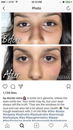 Bigger Eyes Surgery, Fox Eye Before And After, Undereye Fillers Before And After, Eye Trough Filler Before And After, Undereye Filler Before And After, Under Eye Filler Before And After, Eyes Surgery, For Dark Circles Under Eyes, Eye Lift Surgery