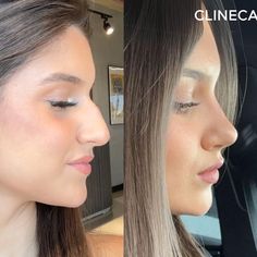 Botched Rhinoplasty, Nose Inspiration Rhinoplasty, Nose Job Before And After Rhinoplasty, Rhinoplasty Inspiration, Nose Job Inspiration Natural, Rhinoplasty Before After, Nose Job Before And After, Nose Job Inspiration, Natural Nose Job