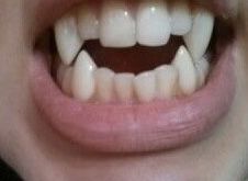 a woman's mouth with white teeth and gums