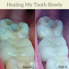 Tooth Pain Remedies, Teeth Remedies, Tooth Decay Remedies, Heal Cavities, Teeth Health, Herbs For Health, Teeth Care