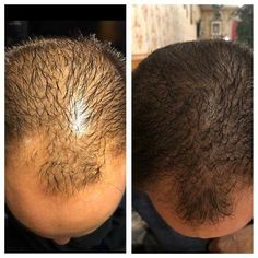 Alopecia Aesthetic, Hair Transplant Before And After, Hairline Transplant Women, Botox Face, Scalp Micropigmentation, Androgenetic Alopecia, Best Hair Transplant, Skin Photo, Long Silky Hair