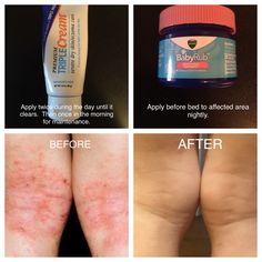 AMAZING RELEIF FOR ECZEMA!!!!! Hoping this helps anyone else affected with eczema.  My little guy had also picked up Molluscum Contagiosum!! We had tried every thing for almost a year to clear it up: pediatrician, dermatologists at Children's in Boston, steroid and antibiotic creams, tea tree oil, apple cider vinegar.  Tried this one day out of desperation. Thought the Vick's might be soothing, could not believe my eyes the next day!!!! MUST BE USED TOGETHER!! If you try to use just one it will Best Tea Tree Oil, Molluscum Contagiosum, Anti Aging Skin Products, Natural Medicine, Tree Oil, Skin Cream, Tea Tree Oil, Cider Vinegar