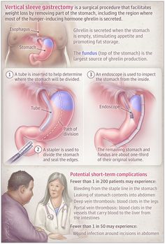 Sleeve Gastrectomy | Bariatric Surgery | JAMA | JAMA Network Cen Review, Medicine School, Medical Notes, Bells Palsy, Sleeve Gastrectomy, Medical Procedures