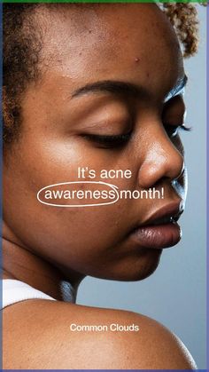 It’s #acneawarenessmonth and we want to spend it with YOU 💙
This month, we’ll deep-dive into acne, debunk myths, share lots of beautiful #realskin content and do everything we can to spread awareness about acne. Learn more about what acne is, why you get acne and much more. Acne Awareness Month, Acne Awareness, Painful Acne, Different Types Of Acne, Moderate Acne, Back Acne, Mild Acne, Severe Acne, Types Of Acne