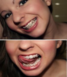 #braces #braceface #girlswithbraces #retainers Braces Girls, Brace Face, Keto Diets