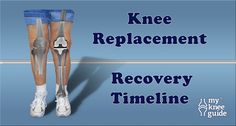 What To Wear After Knee Replacement, Knee Replacement Humor, Knee Scope Surgery Recovery, Knee Replacement Recovery Tips, Rotator Cuff Surgery Recovery, Exercises After Knee Replacement Surgery, Full Knee Replacement, Pt For Knee Replacement, Tummy Tucks Recovery