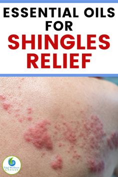 Oils For Shingles, Shingles Pain Relief, Shingles Symptoms, Shingles Remedies, Essential Oils For Shingles, Treating Shingles, Shingles Relief, Shingles Rash, Essential Oil Chart