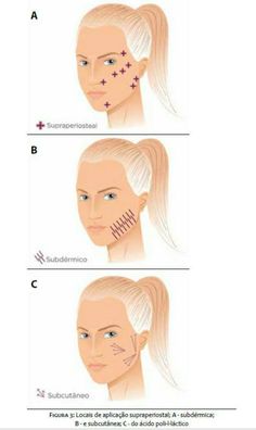 Guia Prático em Harmonização Facial - Vol 2 - ácido hialuronico - Técnicas Básicas de Aplicação - Wattpad Dental Aesthetics, Fat Grafting, Ben Hur, Face Anatomy, Lifting Facial