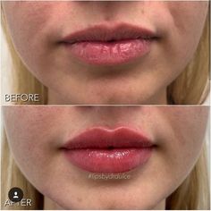 Lip Injections Juvederm, Lip Fillers Juvederm, Dermal Fillers Lips, Lips Fillers, Lips Shape, Kiss Lips