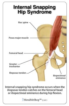 Uneven Hips Symptoms, Clicking Hip Syndrome, Rectus Femoris Stretch, Hip Nerves Anatomy, Psoas Exercises, Iliopsoas Bursitis, Sternocleidomastoid Muscle Stretch, Hip Injuries