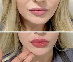 Russian Lips Filler Before And After, Russian Lips Filler, Russian Lips, Port Credit, Rhinoplasty Nose Jobs, Lip Care Tips