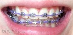 Braces Power Chain, Lavender Braces, Chain Braces, Power Chain Braces, Dental Braces Colors, Braces Colors Combinations, Invisible Teeth Braces, Braces Colors Ideas, Power Chain