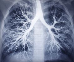 an x - ray image of the lungs