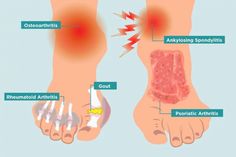 Arthritis in Your Feet: Causes, Symptoms, and Treatment Ways To Heal, Ankle Pain, Hip Pain, Foot Pain, Autoimmune Disease, Chronic Pain, Surgery, Yoga