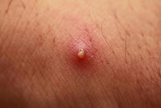 Boils and pimples may have similar appearances, but they often have different causes. Learn how to tell boils from pimples and treat outbreaks. Essential Oil For Boils, Boil Popping Videos, Underarm Pimples, Big Zits, Skin Boil, Big Pimple, Blind Pimple, Dry Skincare, Zits Popping