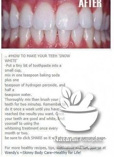 White Teeth Tips, Whiten Teeth Naturally, Best Teeth Whitening Kit, Diy Teething