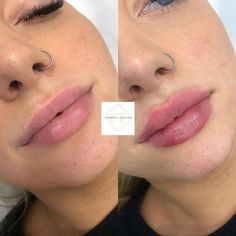 Jt Lips, Lips Injection, Lip Goals, Lip Permanent Makeup