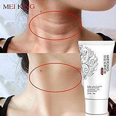 Neck Mask, Neck Wrinkles, Neck Cream