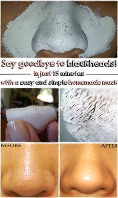 Say goodbye to the unpleasant blackheads by clearing your skin with this simple homemade mask. It is easy to prepare, by using ingredients present in your own personal kitchen. It's only fair to share...004700 Obličejové Masky, Aesthetic Health, Hacks Every Girl Should Know, Blackhead Removal, Remove Blackheads, Beauty Remedies, Beauty Tricks, Homemade Beauty Products