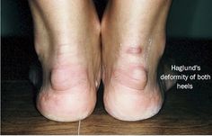 What’s that bump on the back of my heel? | PA Foot and Ankle Associates Bone Spur On Back Of Heel, Heel Spur Symptoms, Heal Spurs, Heel Spur Relief, Lower Back Pain Remedies, Lower Back Pain Causes