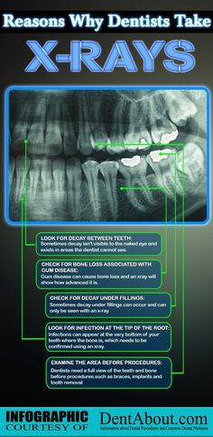 Why dentists take xrays..... Dental Xrays, Dental World, Kedokteran Gigi, Dental Fun, Dental Life, Dental Marketing