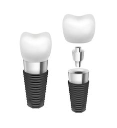 Different Types of Dental Implants Tooth Vector, Tooth Implant, Missing Teeth, Teeth Implants, Dental Implant, Columbia Mo, The Bone, Dental Implants