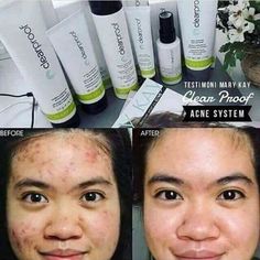 Https://Www.Marykay.Com/Mrs.Ewalker Before And After Acne, Clearproof Mary Kay, Selling Mary Kay, Imagenes Mary Kay, Mary Kay Skin Care, Mary Kay Consultant, Advanced Skin Care, Mary Kay Business, Burdock Root