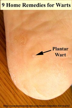 What Causes Warts, Plantar Warts, Types Of Warts, Warts On Face, Home Remedies For Warts, Warts Remedy, Get Rid Of Warts, Natural Cough Remedies, Natural Home Remedies