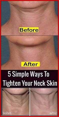 Discover 5 simple and natural wrinkle remedies to tighten your neck skin quickly! These effective anti-aging tips help fade wrinkles under eyes, around the mouth, and on hands. Achieve a glowing complexion and remove signs of aging fast with our skin care solutions. Embrace a youthful look with these wrinkle solutions that work! Perfect for anyone looking to enhance their natural beauty and remove wrinkles naturally. #Skincare #AntiAging #NaturalBeauty #WrinkleRemedies #GlowingSkin Loose Neck Skin, Tighten Neck Skin, Chest Wrinkles, Neck Tightening, Chin Exercises, Tighten Loose Skin, Neck Exercises