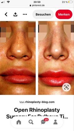 Nose Inspo Front View, Kylie Jenner Nose Job, Kylie Jenner Nose, Bad Nose Jobs, Kylie Jenner Workout, Ethnic Rhinoplasty