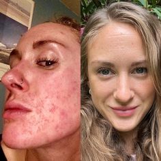 My Healing Journey With Perioral Dermatitis — Well-Being In Bloom Seborrheic Dermitis On Face, Copper Toxicity, Contact Dermitis Rash, Epidermolysis Bullosa, Epidermal Growth Factor