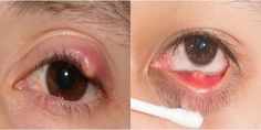 “Dr. Jesna V. Jose discusses chalazion and hordeolum and gives indications for some homeopathic remedies. Relevant remedies include Conium, Hepar, Staphysagria, Silica, Rhlus and Thuja.” Skincare For Oily Skin, Garden Remedies, Light Sensitivity, Baby Shampoo, Homeopathic Remedies, Natural Eyes